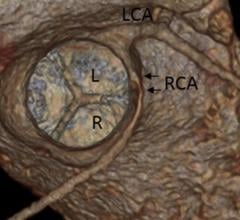 A 3-D CT reconstruction of an anomalous right coronary artery (RCA) can be seen arising from the left sinus of valsalva in a short-axis equivalent view. ASE issues New Guidelines for Multimodality Imaging of Congenital Coronary Anomalies 