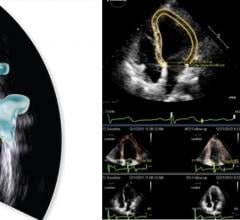 New cardiac ultrasound technologies featured at the American Society of Echocardiography 2021 Virtual Meeting include intracardiac ultrasound (ICE) imaging from Biosense Webster (left), and cloud-based, vendor-neutral strain imaging from Epsilon Imaging (right).