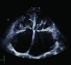 New International Report Provides Comprehensive Guide to Imaging in Chagas Heart Disease