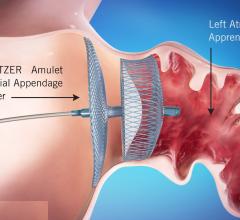 The Abbott Amplatzer Amulet left atrial appendage (LAA) transcatheter occlusion device. It received FDA clearance in August 2021. #LAA