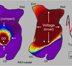 Charge Density Mapping Eliminates Repeat Ablation for Atrial Fibrillation at One Year