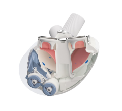 Aeson total artificial heart showing Open view with pumps and electronics (blue), blood chambers (maroon) and conduits (top, white). Image courtesy of Carmat.