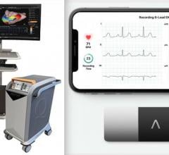 The AcQMap 3D Imaging and Mapping System, left, and the AliveCor KardiaMobile device and app for personal ECG monitoring using a smartphone, right. The companies plan to use remote monitoring to see if it helps improve care for ablation patients.