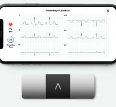 AliveCor's KardiaMobile six-lead ECG system that works on smartphone platforms. It was cleared in 2019 and includes artificial intelligence algorithms to help identify arrhythmias. 