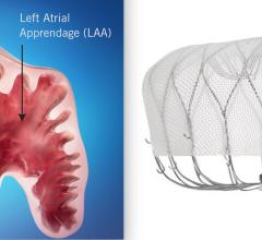 The two FDA-cleared transcatheter LAA occlusion devices on the U.S. market were compared in the SWISS-APERO and SEAL FLX trials presented at TCT 2021. Left is the Abbott Amulet device, right is the newest generation Watchman FLX device.