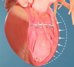 Positive Safety, Efficacy Data Reported on AccuCinch Heart Failure Device