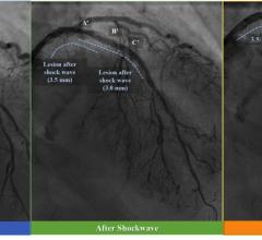 Shockwave Initiates U.S. Pivotal Study for Coronary Intravascular Lithotripsy