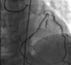 Angiogram of a STEMI patient.