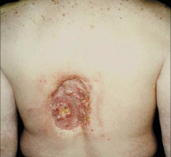 A patient injuried by extreme exposure to X-ray radiation during an angiography procedure, which is included among the images in the American College of Cardiology (ACC) consensus document. Angiography skin burn.
