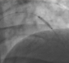 Study Finds Significant Variability in Doctors Angioplasty Death Rates