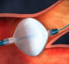 The Medtronic Arctic Front cryoballoon balloon was used a a front-line treatment of AF in the EARLY-AF trial. It was found to be better than anti-arrhythmic drugs in preventing the recurrence of abnormal heart rhythm (atrial tachyarrhythmia, atrial fibrillation), and improve patient well-being.  #AHA #AHA2020 #AHA20