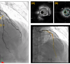 A representative case in which artificial intelligence–based quantitative coronary angiography (AI-QCA) showed a good correlation with intravascular ultrasound (IVUS) observation. %DS: percent diameter stenosis; DRD: distal reference diameter; LAD: left anterior descending artery; LCX: left circumflex artery; MLD: minimal luminal diameter; PRD: proximal reference diameter; RCA: right coronary artery; Ref.D: reference diameter. 