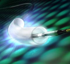 SeQuent Please ReX Drug-coated Balloon Catheter Receives FDA Breakthrough Device Designation