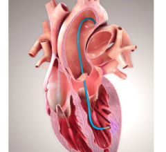 ECG, pulmonary. disease