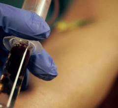 FDA Clears Abbott's High Sensitivity Troponin-I Blood Test