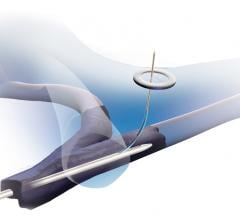 The Bluegrass Vascular Surfacer System is designed to reliably, efficiently and repeatedly gain central venous access by inserting the Surfacer System through the right femoral vein and navigating it up through the patient’s venous system with an exit point in the right internal jugular vein, the optimal location for placing a central venous catheter. 