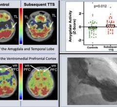 Researchers found a relationship between stress-associated neurobiological activity on 18F-FDG PET-CT imaging and risk for subsequent Takotsubo syndrome impacting the heart.
