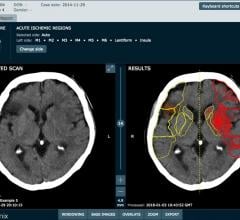 Brainomix Secures $9.8m Investment to Tackle Strokes With AI