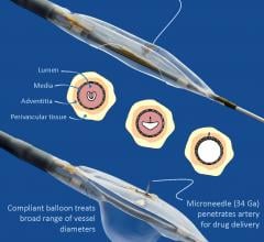 Mercator MedSystems Announces First Enrollment in TANGO Trial for Below-the-Knee Vascular Disease