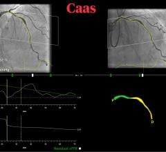 The Pie Medical Imaging angiography-based vessel fractional flow reserve (CAAS vFFR) technology can use angiography imaging alone to assess FFR without the need for pressure wires or  adenosine.