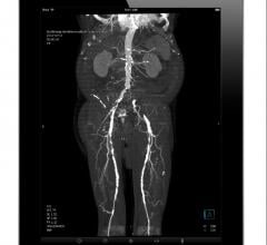 New AHA Statement Highlights Need for Early Diagnosis, Treatment With Critical Limb IschemiaCTA image of a patient with severe peripheral artery disease (PAD) viewed on a tablet device using Siemens syngo.via webviewer.