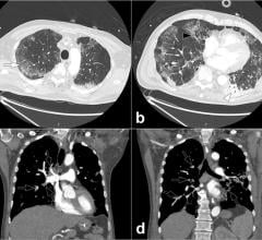 Examples of pulmonary embolism clots caused by COVID-19 seen on a chest CT. From the journal Radiology