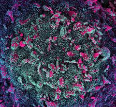 Coronavirus SARS-CoV-2 colorized scanning electron micrograph of a cell (pink) heavily infected with SARS-CoV-2 virus particles (teal and purple), isolated from a patient sample. Image courtesy of NIAID. MIS-C Multisystem inflammatory syndrome in children. #COVID19