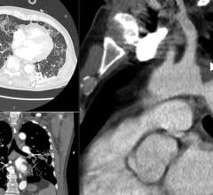 Examples of COVID-19 caused clotting with multiple pulmonary embolisms (PE) in left image, and a large thrombus in the aortic arch. Images courtesy of RSNA and Margarita Revzin et al. Find more clinical images of COVID.