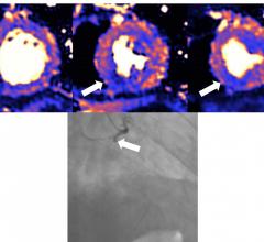 MRI scan of a damaged heart. Blue means reduced blood flow, orange is good blood flow. In this figure the inferior part of the heart shows dark blue, so the myocardial blood flow is very reduced. The angiogram shows the coronary artery which supplies the blood to this part of the heart is occluded. The three colored MRI images show different slices of the heart — the basal mid and apical slices. Image courtesy of European Heart Journal #COVID #COVID19