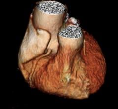 CT Shows Enlarged Aortas in Former Pro Football Players