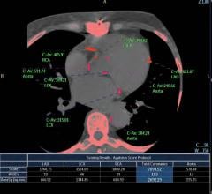 calcium scan, CAC score, CT, heart disease screening, prevention, JACC Cardiovascular Imaging study