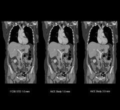 FDA Clears AiCE Image Reconstruction on Canon's Aquilion Precision CT