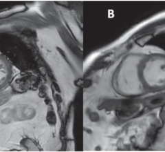 85-year-old patient with ischemic heart disease, who underwent cardiac MRI at 3 T