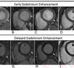 T1-Based Criteria for Myocarditis on Cardiac MRI in Patients With Recent COVID-19 mRNA Vaccination: Early gadolinium enhancement (EGE) compared with precontrast SSFP sequence (not shown) is observed on early postcontrast short-axis SSFP images in (A) 16-year-old male, (B) 17-year-old male, (C) 16-year-old male, and (D) 19-year-old male, and on early postcontrast short-axis perfusion image in (E) 17-year-old male (arrow, A-E). Late gadolinium enhancement (LGE) is also present (arrows) in all 5 patients (F, G