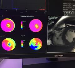 Machine Learning Could Offer Faster, More Precise Cardiac MRI Scan Results