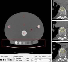 The Mindways Solid phantom with volume of interest in the quality assurance phantom (red circles, left side). A participant's noncontrast-enhanced axial CT (right side) with volume of interest (yellow circles) in the trabecular bone compartment of three vertebrae for bone mineral density measurements. Image courtesy of Radiological Society of North America
