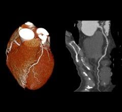 CTA, CT angiography, predict heart attacks, Radiology study