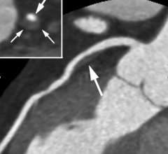 Readers of cardiac computed tomography (CT) exams often over estimate the risk if coronary artery disease (CAD) according to a new core-lab analysis from the PROMISE Trial. #RSNA17, #RSNA2017, #SCCT