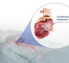 The Cardiovalve transcatheter mitral valve replacement (TMVR) technology for patients suffering from mitral or tricuspid regurgitation (MR and TR), is undergoing clinical trials in Europe.