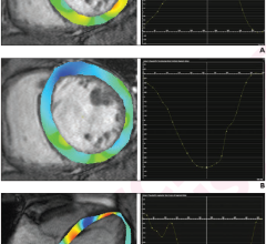 80-year-old patient with nonischemic dilated cardiomyopathy. Ejection fraction was 25.2%. Patient underwent cardiac MRI. A. Radial strain overlay on short-axis cine image and corresponding graph show global radial strain measurement, yielding value of 10.8%. B. Circumferential strain overlay on short-axis cine image and graph show global circumscribed strain measurement, yielding value of -8.5%. C. Longitudinal strain overlay on 4-chamber cine image and graph show global longitudinal strain measurement, yie