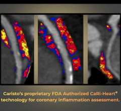 FDA Grants De Novo Authorization for Coronary Inflammation Quantification Technology