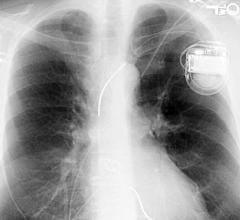 New Tool Predicts Benefits and Risks of Implantable Defibrillator for Heart Failure Patients