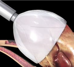 CorInnova Awarded Seminal Patent for Minimally Invasively-Delivered Soft Robotic Heart Device