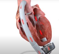 The CorWave LVAD uses a pulse pump rather than a rotary pump to move blood, so it more closely simulates the movement of blood in a read heart.