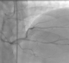Bypass Surgery and Coronary Stenting Yield Comparable 10-Year Survival