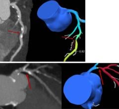 An advanced CT test can identify individuals with stable angina at a reduced risk of three-year adverse outcomes despite their having a high coronary artery calcium score 