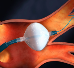Cryoablation involves guiding a small tube into the heart and inflating a small balloon to kill problematic tissue with cold temperatures. Image courtesy of Medtronic 