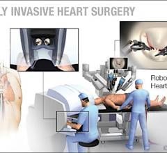 Mayo Clinic uses the Da Vinci surgical robot to perform minimally invasive mitral valve surgeries. 