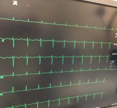 EKG With Artificial Intelligence Reliably Detects Heart Failure Precursor