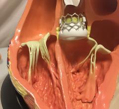 Health Canada has approved the expanded use of the Edwards Lifesciences Sapien 3 and Sapien 3 Ultra transcatheter aortic valve replacement (TAVR) heart valves for the transfemoral treatment of patients diagnosed with severe symptomatic aortic stenosis who are at low risk for open-heart surgery. #TAVR #TAVI